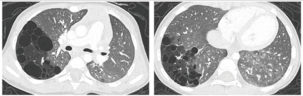 図6　症例4：Turbo Flash Spiralを用いた鎮静下の小児の撮影