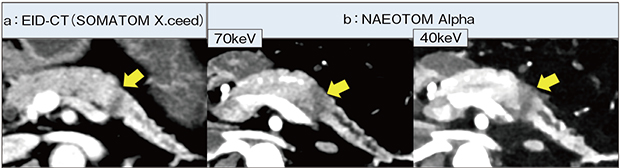 図1　NAEOTOM Alphaによる膵尾部がんにおける低keV画像の評価