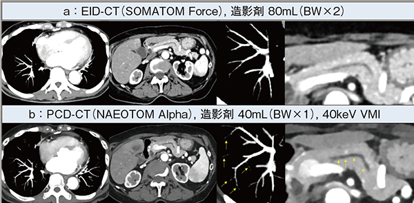 図3　低keVによる造影剤減量効果