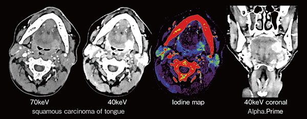 図3　Spectral解析による舌基部の腫瘍浸潤の評価