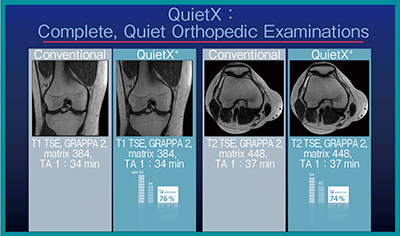 図2　筋骨格領域の通常のT1 TSEとQuietXの比較