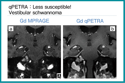 図4　症例4：80歳代，女性，前庭神経鞘腫 a：造影MPRAGE，b：造影qPETRA