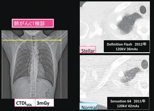 図7　肺がんCT検診画像におけるストリークアーチファクトの比較
