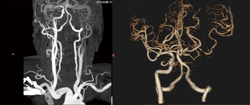 図2　症例2のCTA画像（Definition Flash） 左内頸動脈閉塞。中大脳動脈の末梢は描出されている