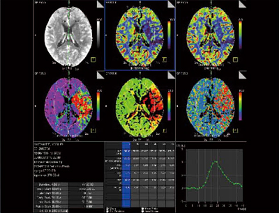 図3　症例2：CTPによる脳血流測定 （syngo VPCT Neuro）