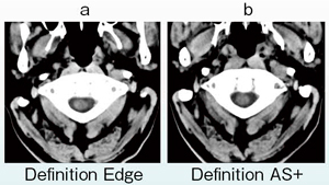 図7　頭部CT　C1-大後頭孔レベルの脊髄の描出。aのDefinition Edgeの方がシャープな切れ味のある画質となっている。