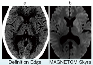 図8　超急性期脳梗塞のearly CTサイン a：院内発症20分後の頭部単純CT画像（Definition Edge）。early CTサインが認められる。 b：45分後のMRIの拡散強調画像（DWI）