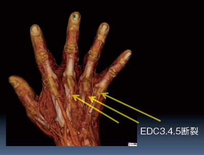 図7　症例5：中指，環指，小指伸展障害