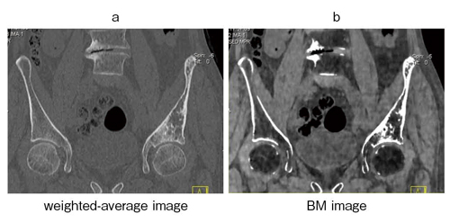 図3　72歳，男性，骨悪性リンパ腫の治療後
