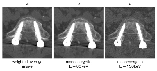 図6　 metal artifact reduction