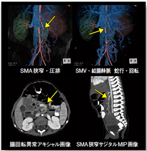 腸回転異常