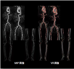 急性大動脈解離と下肢動脈血栓症を有す患者の造影