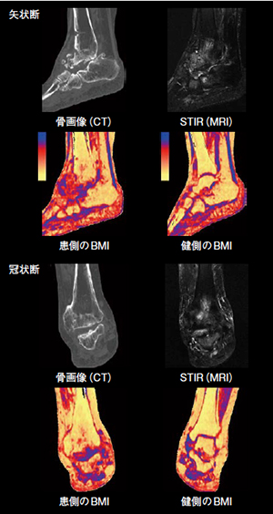 変型性足関節症における骨髄浮腫の描出