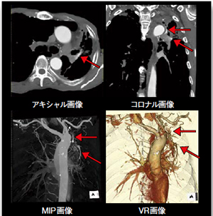 低管電圧（80kV）を使用した胸部CTA