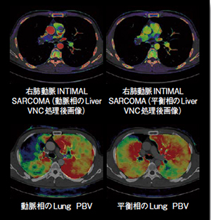 右肺動脈INTIMAL SARCOMAと血栓の鑑別