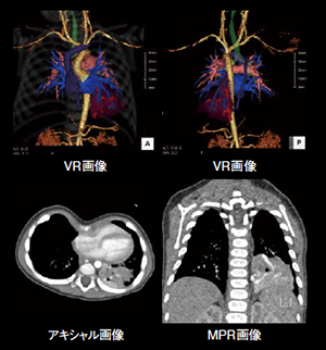小児における低被ばく撮影