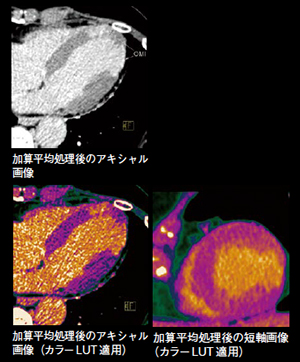 画像加算平均処理を用いた遅延造影CTによる心筋梗塞の描出
