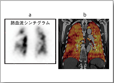 図1　CTEPHの肺血流シンチグラム（a）とLung PBV（b）