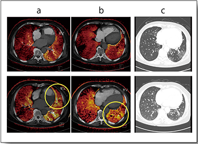 図6　症例4：Lung PBVとmosaic perfusionの治療前（上段）と治療後（下段）
