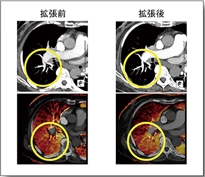 図8　症例5：CTA（上段）とLung PBV（下段）の血管拡張術前後の比較