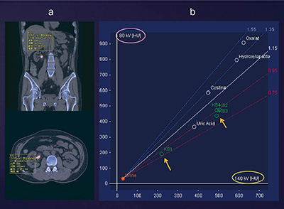 図8　症例2：腎結石のサイズと体積の自動計測結果（a）と腎結石の性状を示すプロット図（b）