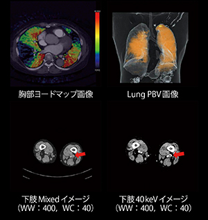 深部静脈血栓症に対する緊急造影CT
