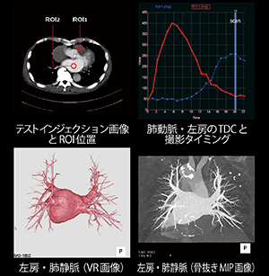 心臓カテーテルアブレーション術前低管電圧低造影剤量CT