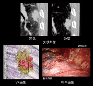 肺癌術前検査における呼吸動態撮影を利用した胸壁浸潤評価
