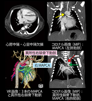 新生児複雑心奇形