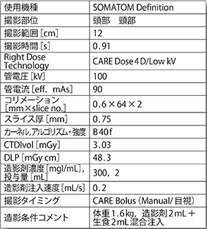 心不全を呈した新生児の脳動静脈奇形