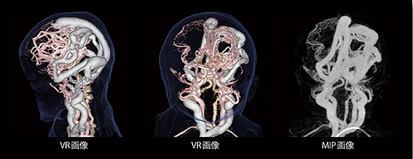 心不全を呈した新生児の脳動静脈奇形