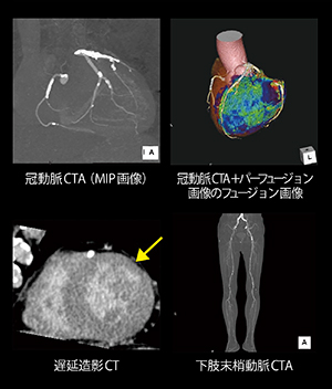 包括的心臓CTと下肢動脈CTAのone-stop shop imaging