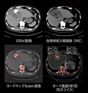 肝がんTACE治療後のリピオドール定量