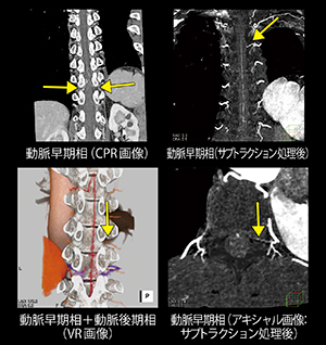 70kV Dual Powerを用いた脊髄動静脈瘻の描出