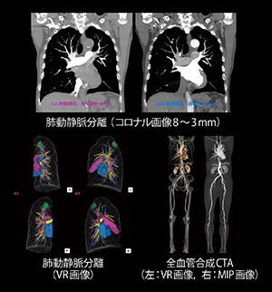 希釈造影併用にて肺動静脈分離＋腹〜下肢CTA