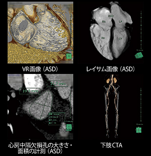 心房中隔欠損症（ASD）