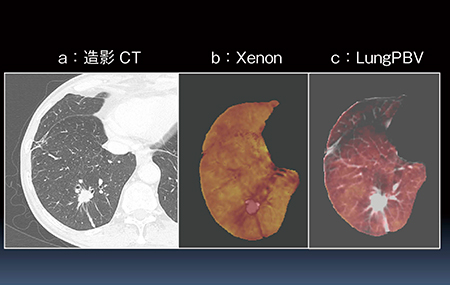 図4　肺換気（Xenon）画像（b）と肺血流（LungPBV）画像（c）（69歳，男性，喫煙者，肺腺癌症例）