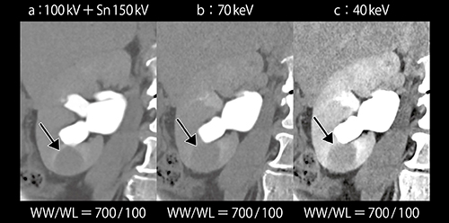 図2　Mono＋の40keV画像（c）による腎腫瘍の描出