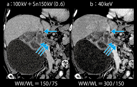 図3　症例1：Mono＋の40keV画像による低造影剤量での静脈描出