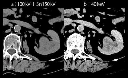図6　症例2：Mono＋の40keV画像による造影剤20mLでの腎実質相の描出