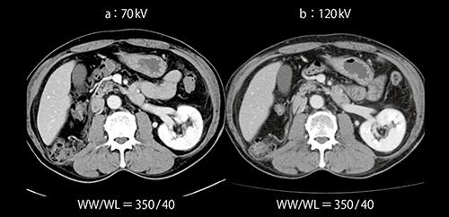 図8　症例3：70kVを用いた低造影剤量での腎の造影効果（体重72kg）