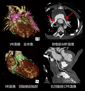 心電図同期Sequenceモードによる小児心臓2beat撮影