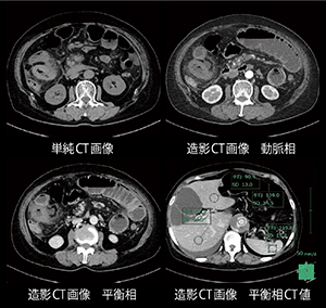 高度腎機能低下患者に対する低管電圧撮影を駆使した緊急造影検査