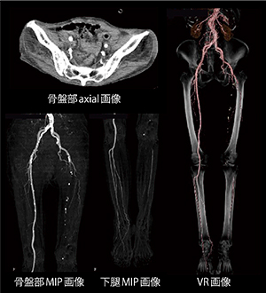 ルーチン下肢CTA Low-kVによる被ばく，造影剤低減症例