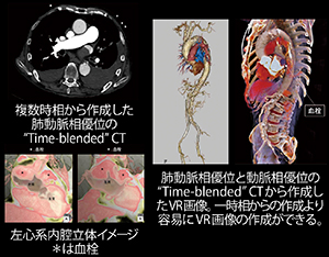 少量造影剤と4D撮像で達成した肺動脈および心臓，大動脈評価