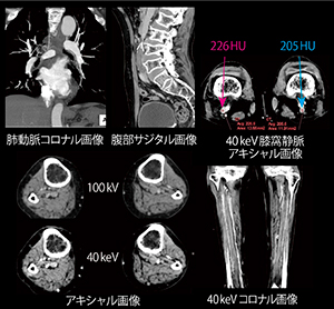 下腿部DVT検出に対するDual Energy追加撮像の有用性