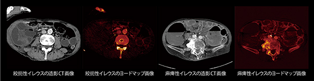 絞扼性イレウスの鑑別診断におけるヨードマップ画像の有用性