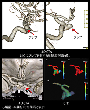 心電同期4D撮影による脳動脈瘤ブレブ評価
