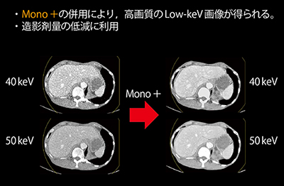 図3　Mono＋を併用したmonoenergetic image