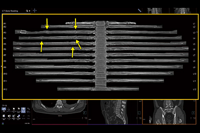 図6　CT Bone Readingによる骨折の観察